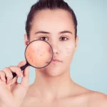 Come far scomparire l’acne durante la notte! Tricks&Skills