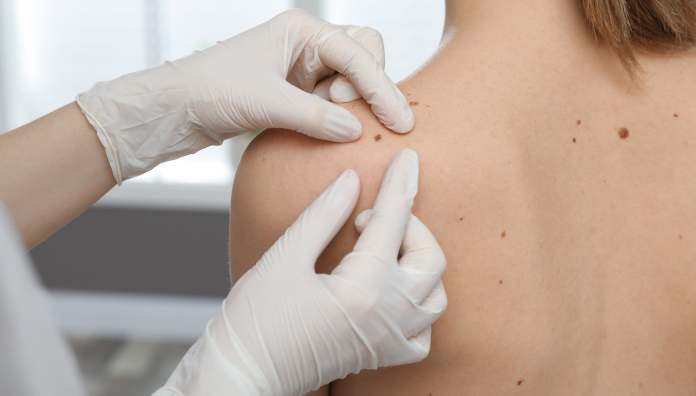 Melanoma: prof Mercuri: «Attenti anche ai puntini rosa o rossi»